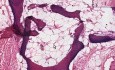 Myositis ossificans - Histopathology of soft tissue