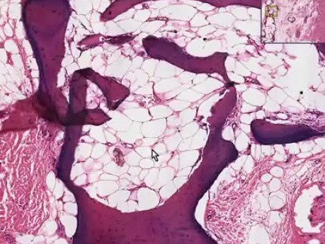 Myositis ossificans - Histopathology of soft tissue