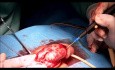 Nesbit Yachia's Technique Modification for Complex Penile Curvature