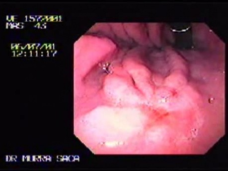 Early Gastric Carcinoma With Signet Ring Cells - Endoscopy (1 of 3)