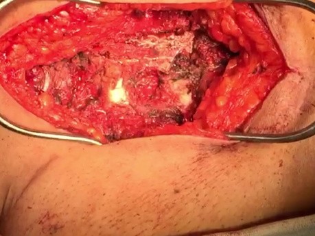 Patient with Penetrating Sternal Fracture and Heart Damage