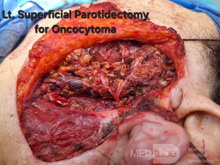 Left Parotid Oncocytoma