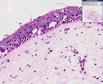 Nose - Nasal Polyp