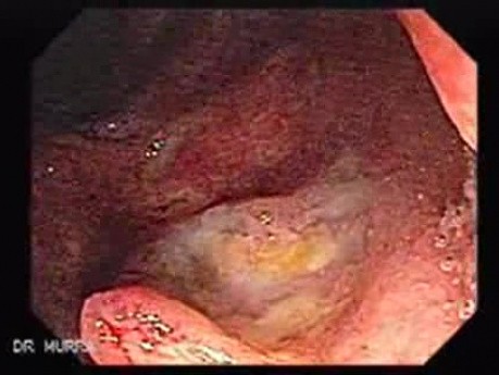 Multiple Rectal Ulcers (1 of 110)