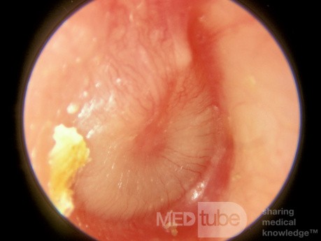 Acute Otitis Media