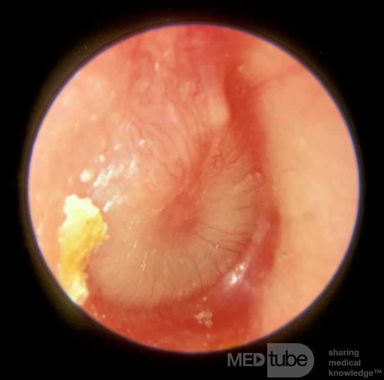 Acute Otitis Media