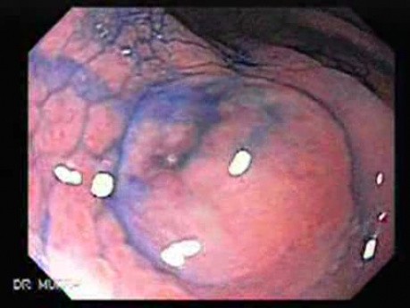 Gastric Carcinoid Tumor (4 of 4)