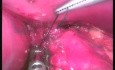 Fundoplication - SILS