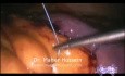 Surgery Roux in Y Gastric Bypass
