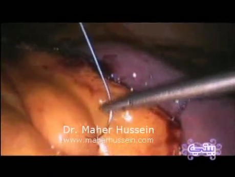 Surgery Roux in Y Gastric Bypass