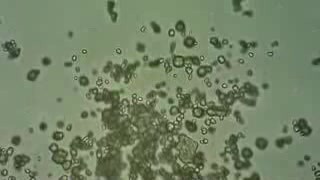 Urinoscopy - Cylindruria - 2