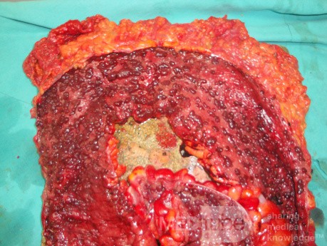 Multiple Rectal Ulcers (87 of 110)