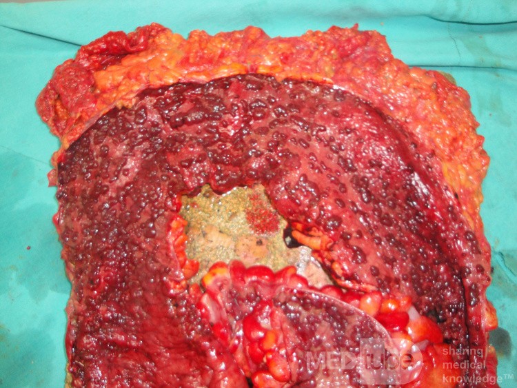 Multiple Rectal Ulcers (87 of 110)
