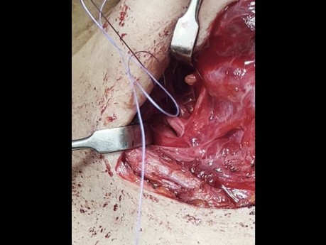 We May Have a Higher Incidence of Rt Nonrecurrent Recurrent Laryngeal Nerve in our Locality, Please Take Care