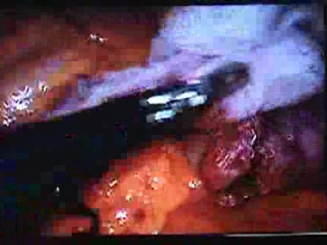 Jejunal Gastrointestinal Stromal tumor (GIST) (81 of 86)