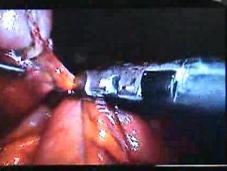 Jejunal Gastrointestinal Stromal tumor (GIST) (29 of 86)