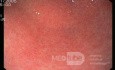 Endoscopy - Chronic Gastritis