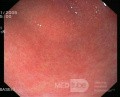 Endoscopy - Chronic Gastritis