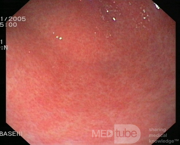 Endoscopy - Chronic Gastritis