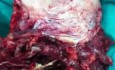 Placenta Previa Invading the Lower Uterine Segment - Surgical Treatment of Parous Woman