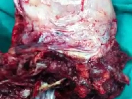 Placenta Previa Invading the Lower Uterine Segment - Surgical Treatment of Parous Woman