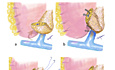 Symplified Technique of Pancreaticogastrostomy