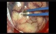 Parietal Glioma