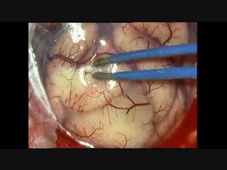 Parietal Glioma