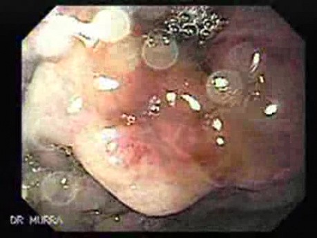 Gastric Varices Rosettes Formation (1 of 22)