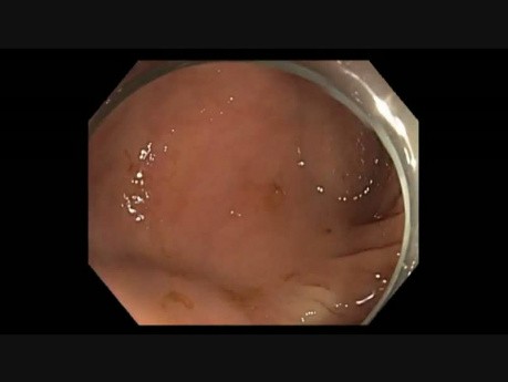 Colonoscopy - Cecum - Subtle Lesion