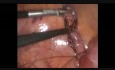 Laparoscopic Appendectomy
