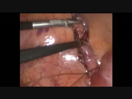 Laparoscopic Appendectomy