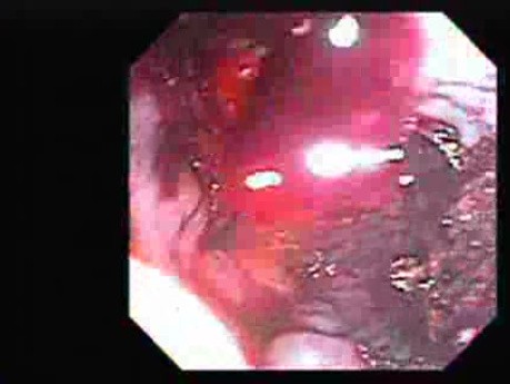Hemorrhage After Ligation - Varix with a Blood Clot