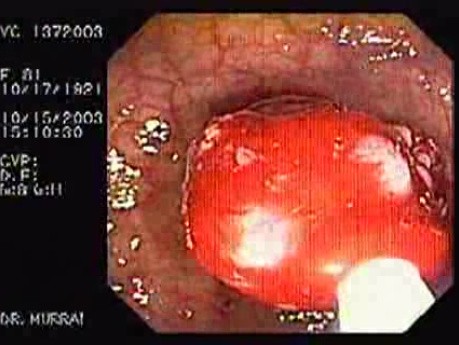 Tubulo - Villous Adenoma - Endoscopy (22 of 28)