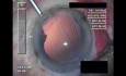 Cataract Surgery - Part 5