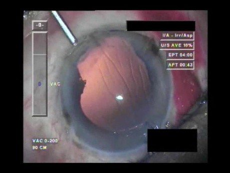 Cataract Surgery - Part 5