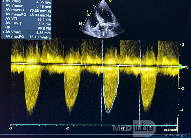 A Case of Severe Aortic Stenosis