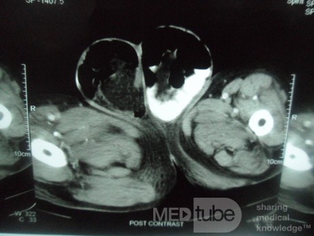 CT Abdomen In Patient With Bilateral Inguinal Hernia 