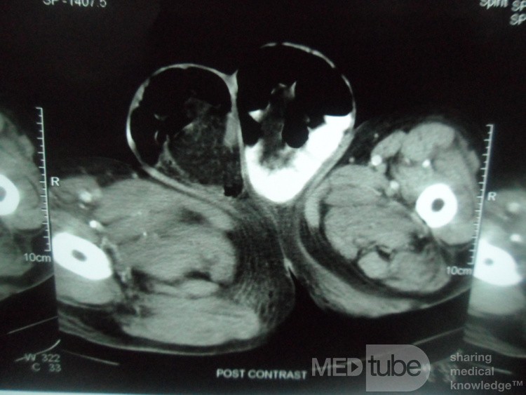 CT Abdomen In Patient With Bilateral Inguinal Hernia 