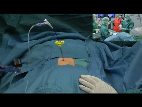 Kyphoplasty Spinal Fracture