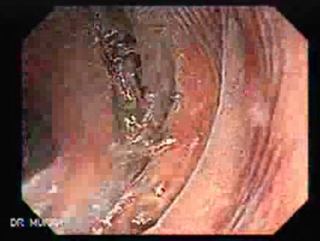 Melanosis Coli (3 of 5)