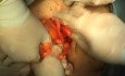 Prolapse of the Uterus - Sling Procedure, Part 2