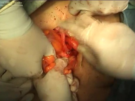 Prolapse of the Uterus - Sling Procedure, Part 2