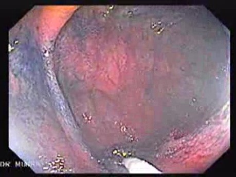 Sessile Tubulovillous Adenoma (10 of 13)