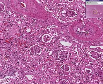 Kidney - Chronic Transplant Rejection