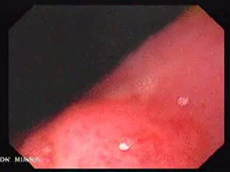 Gastric Polyp (3 of 7)