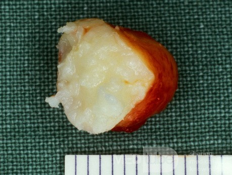Epidermal Cyst [surgical specimen]