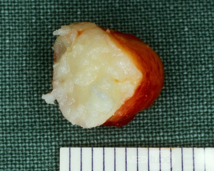 Epidermal Cyst [surgical specimen]
