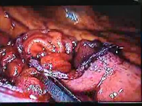 Jejunal Gastrointestinal Stromal tumor (GIST) (48 of 86)