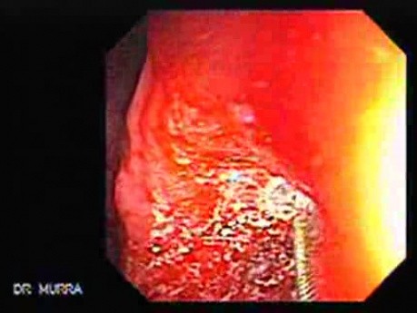Gastric Cicatrization With Pylorus Stenosis (17 of 23)